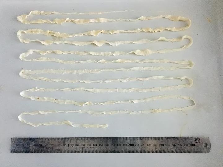 肉千万不能这样吃!有人因此贫血,颅内病变还可能诱发癫痫
